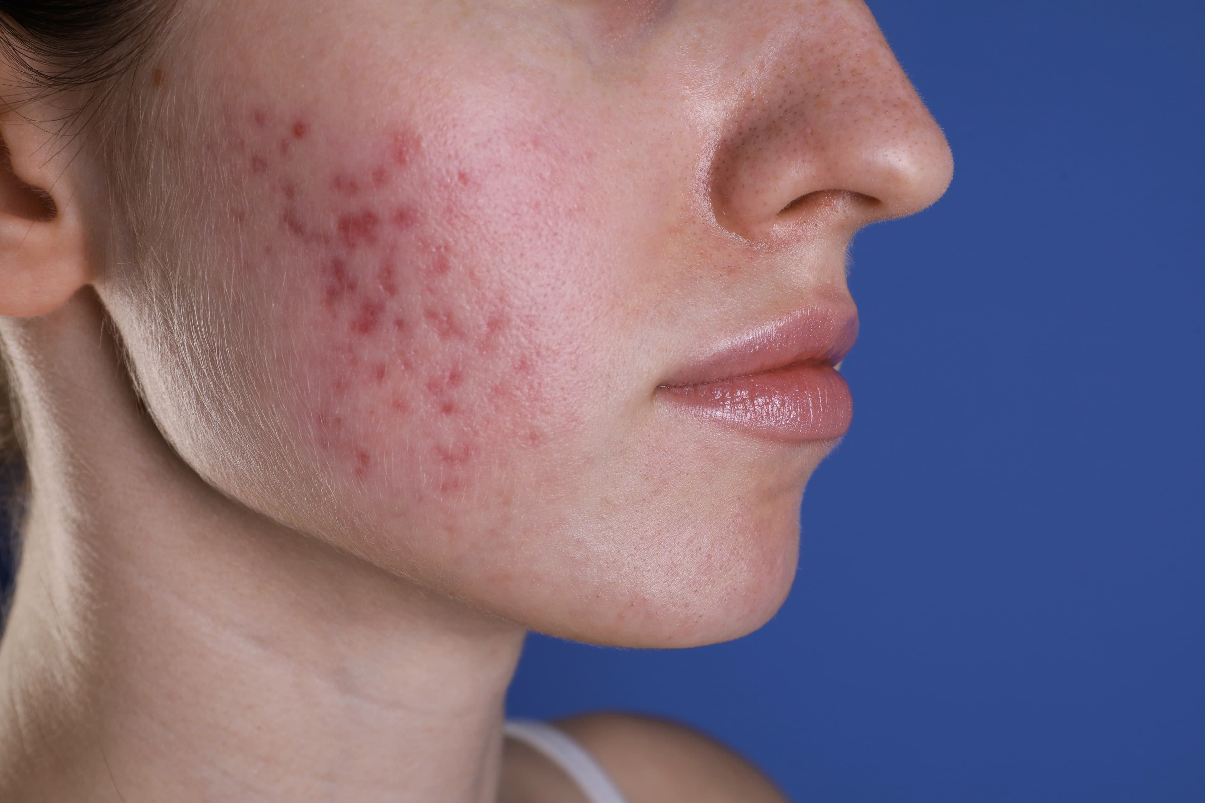 Red Spots Everything You Need to Know