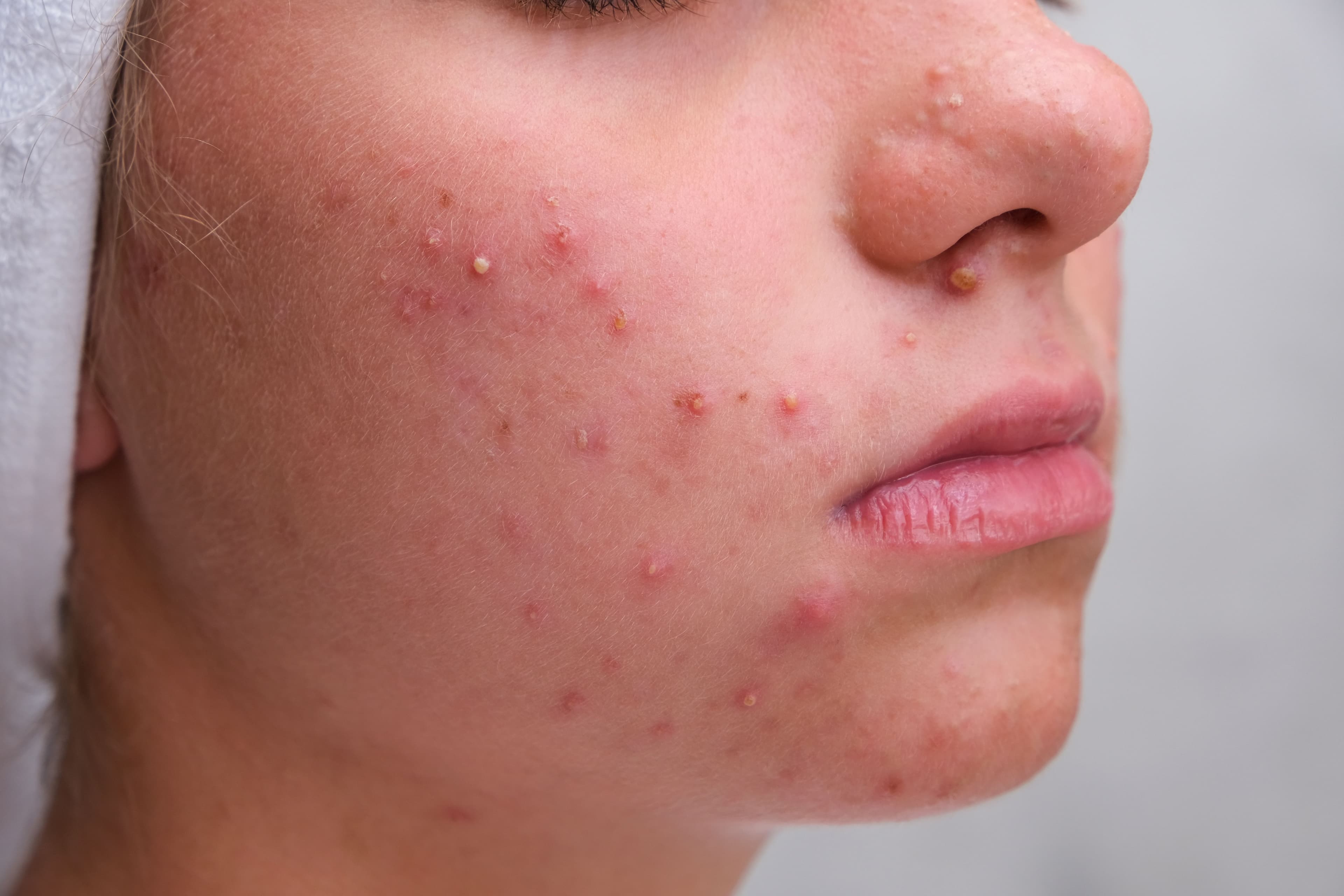 Acne Everything You Need to Know