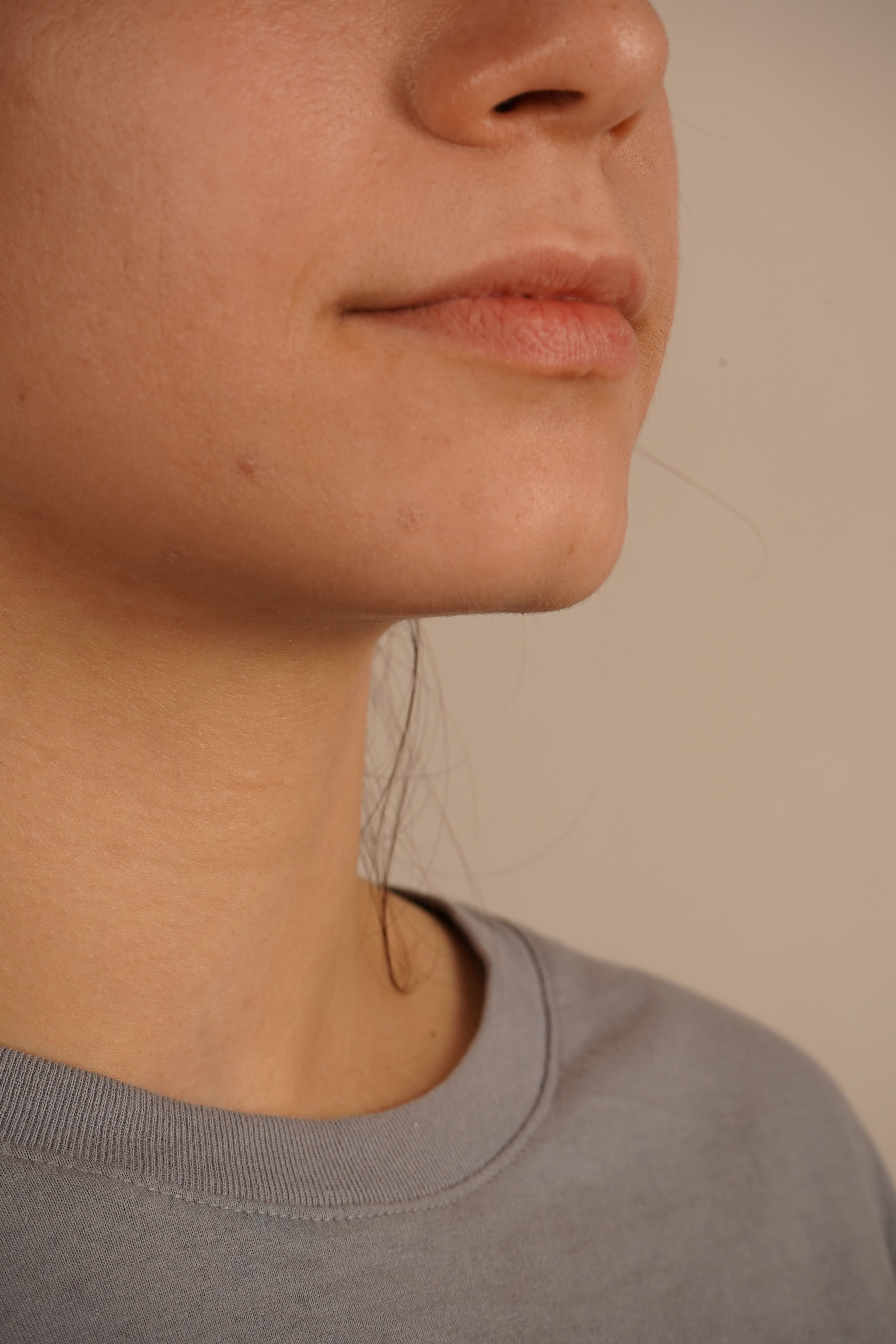 Say Goodbye to Unwanted Facial Hair smaller image