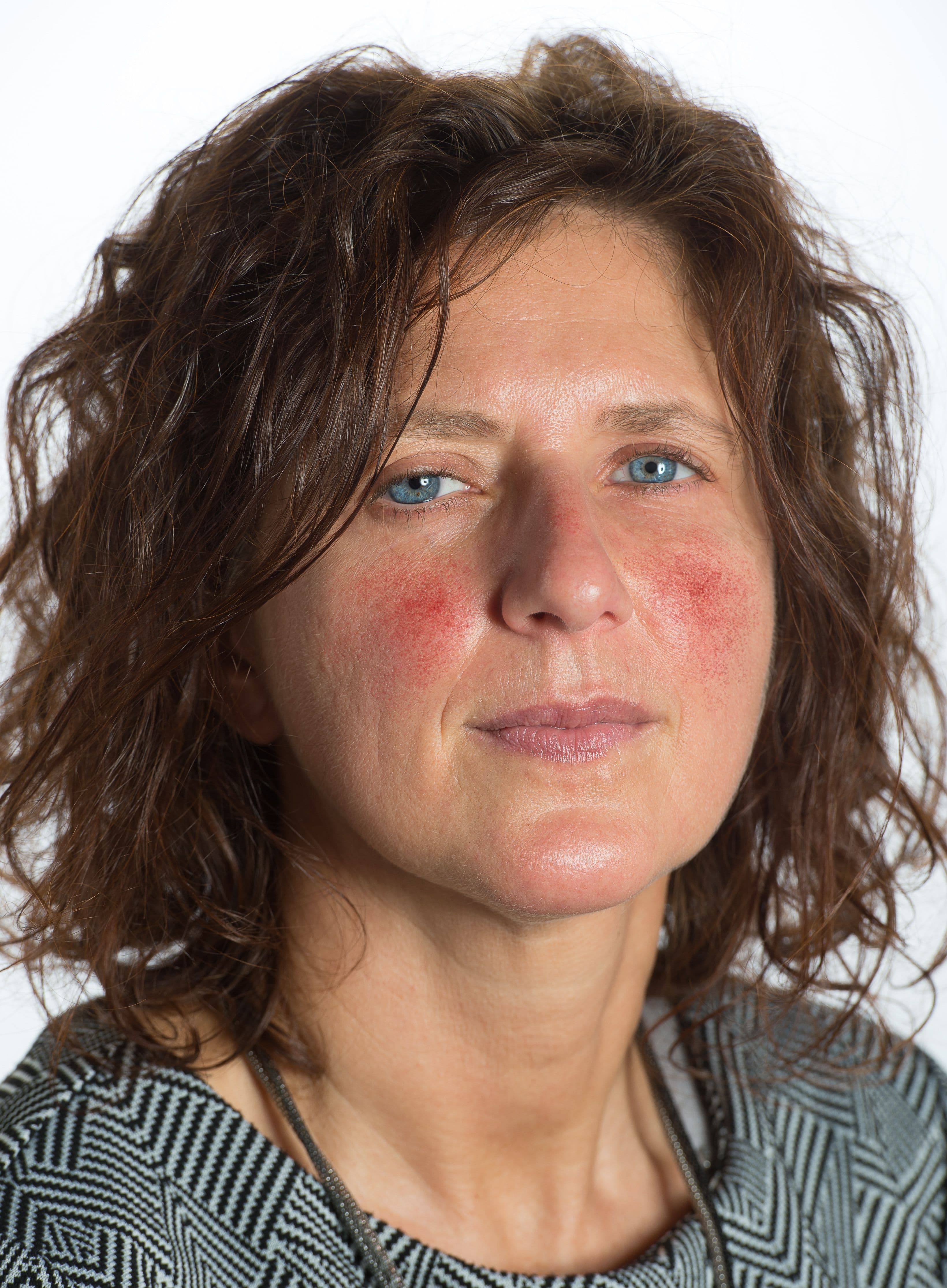 Rosacea Everything You Need to Know